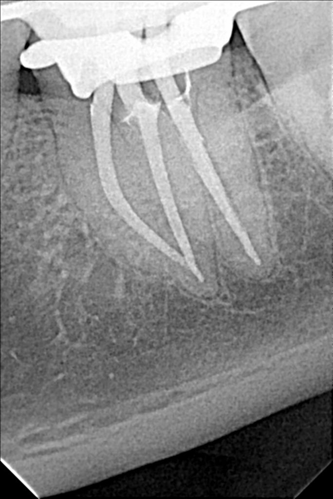 Endodoncia rotatoria