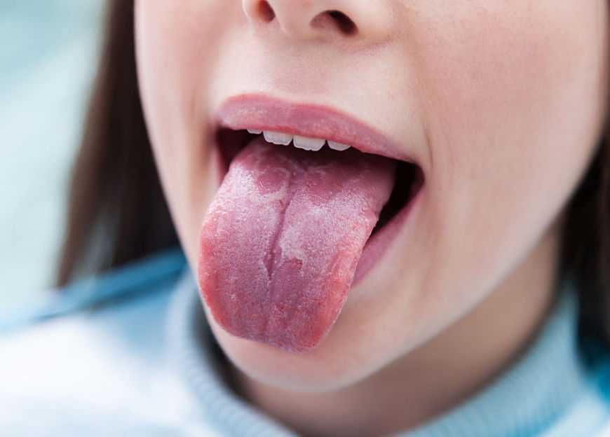 Glositis migratoria benigna o como cuidar de tu lengua